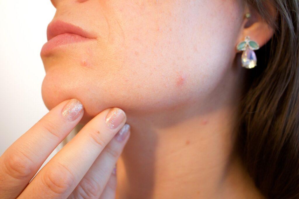 How To Know If Acne Is Hormonal