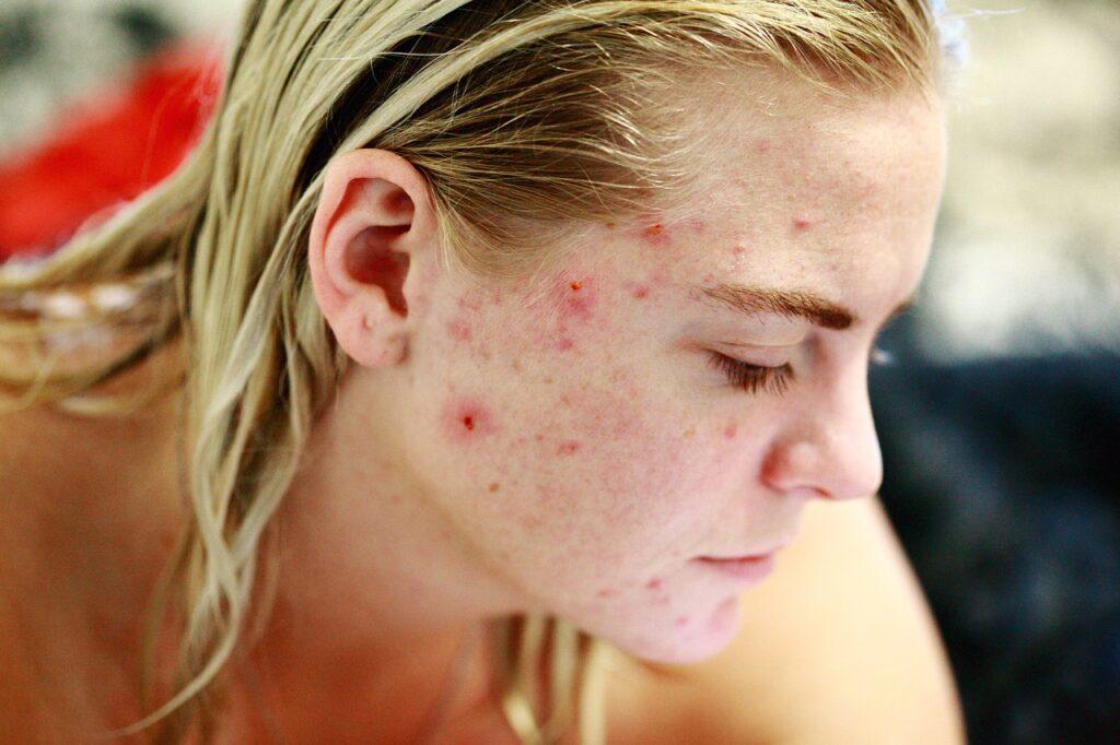 Does Thinking About Acne Make It Worse